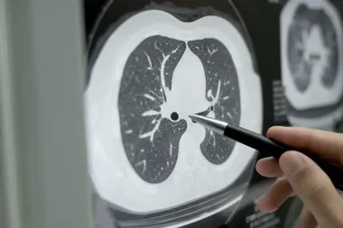 Obraz do artykułu: Bezpłatna tomografia płuc w Małopolsce. Kto może skorzystać z programu?